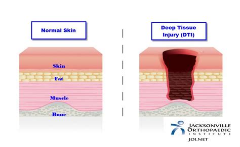 dti acronym|dtis medical.